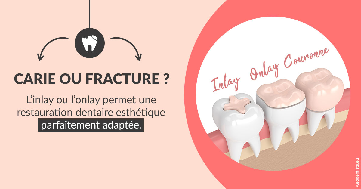 https://dr-charles-amelie.chirurgiens-dentistes.fr/T2 2023 - Carie ou fracture 2