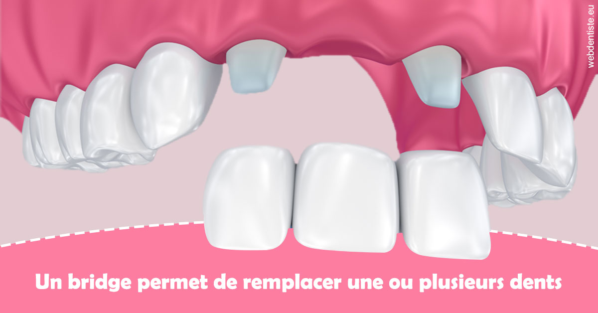 https://dr-charles-amelie.chirurgiens-dentistes.fr/Bridge remplacer dents 2