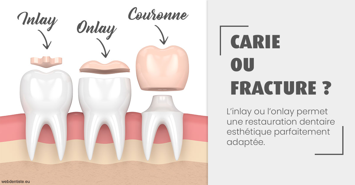 https://dr-charles-amelie.chirurgiens-dentistes.fr/T2 2023 - Carie ou fracture 1