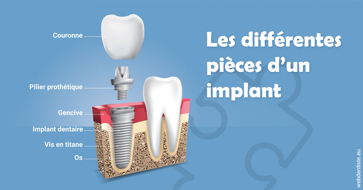 https://dr-charles-amelie.chirurgiens-dentistes.fr/Les différentes pièces d’un implant 1
